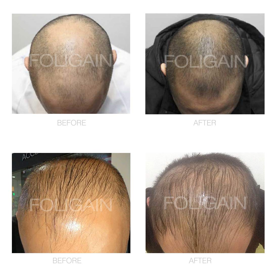 FOLIGAIN Minoxidil 5% Hair Regrowth Treatment For Men 3 Month Supply