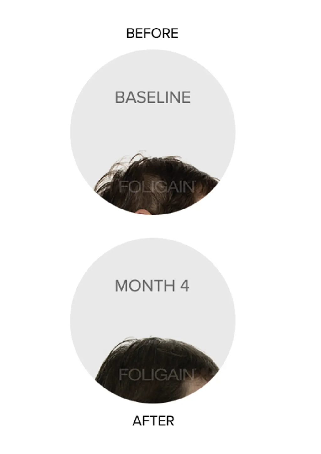 FOLIGAIN Triple Action Complete Formula For Thinning Hair For Women with 10% TRIOXIDIL®