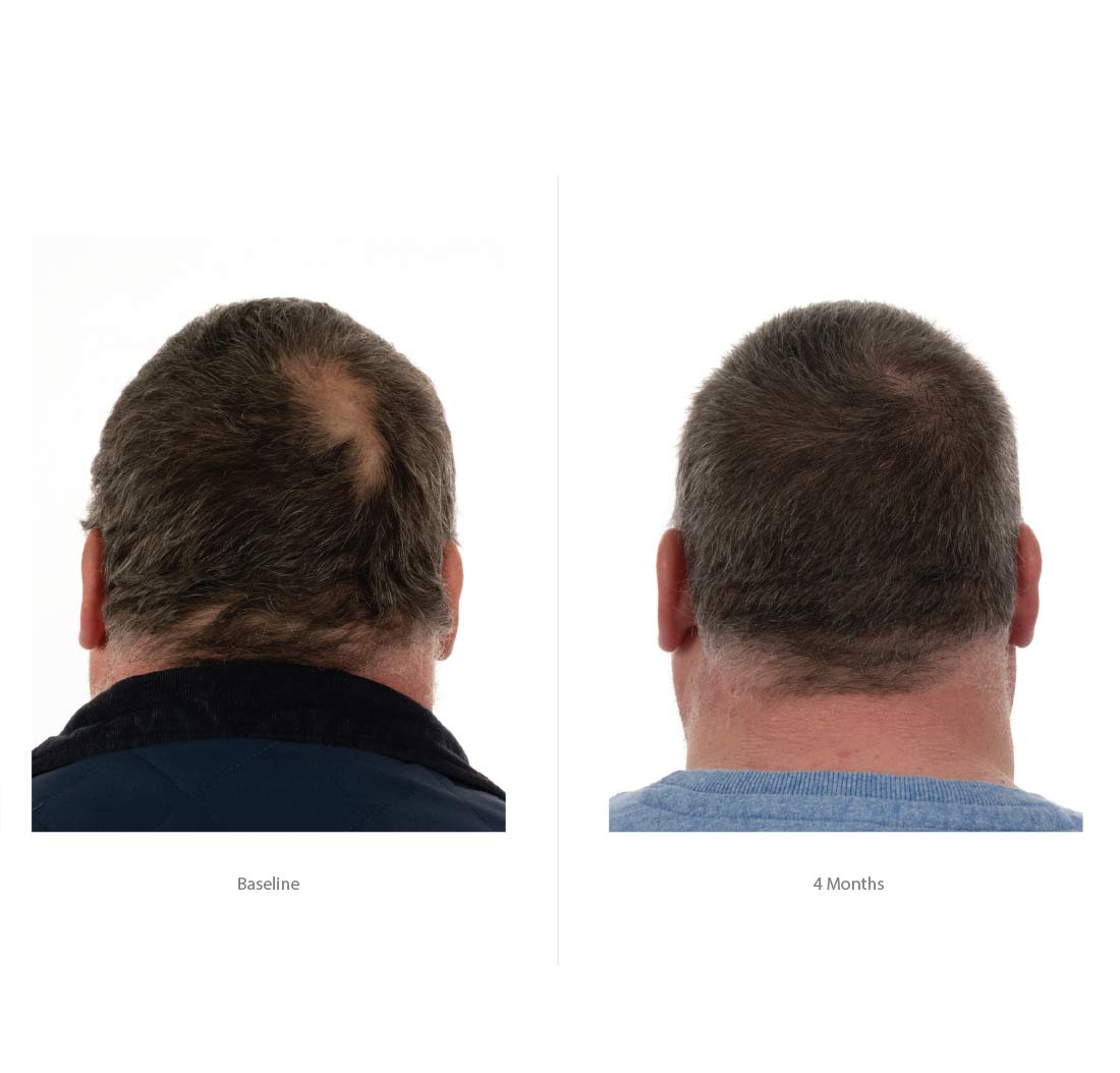 FOLIGAIN Triple Action Conditioner For Thinning Hair For Men with 2% TRIOXIDIL® 473ml