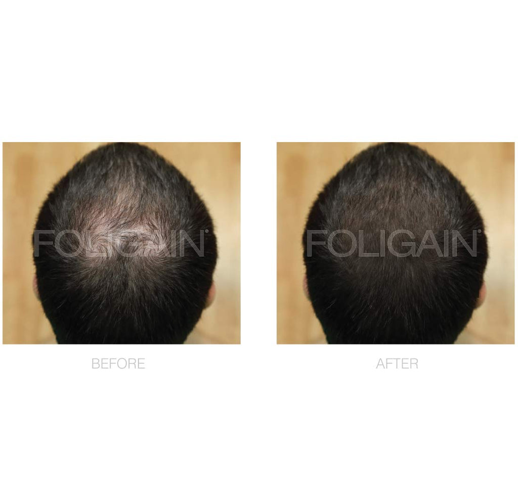 FOLIGAIN Minoxidil 5% Hair Regrowth Foam For Men 3 Month Supply