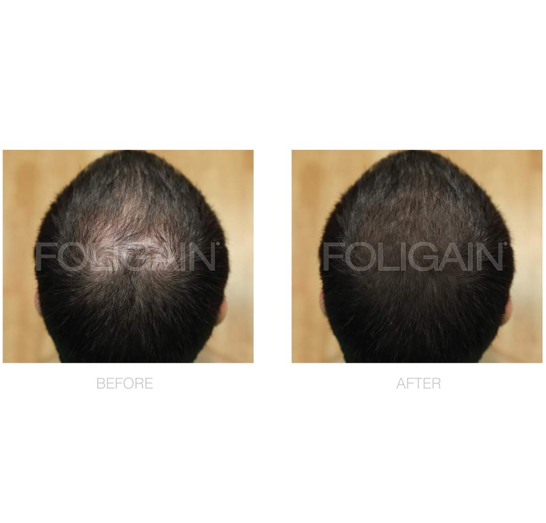FOLIGAIN Low Alcohol Minoxidil 5% Hair Regrowth Treatment For Men 3 Month Supply