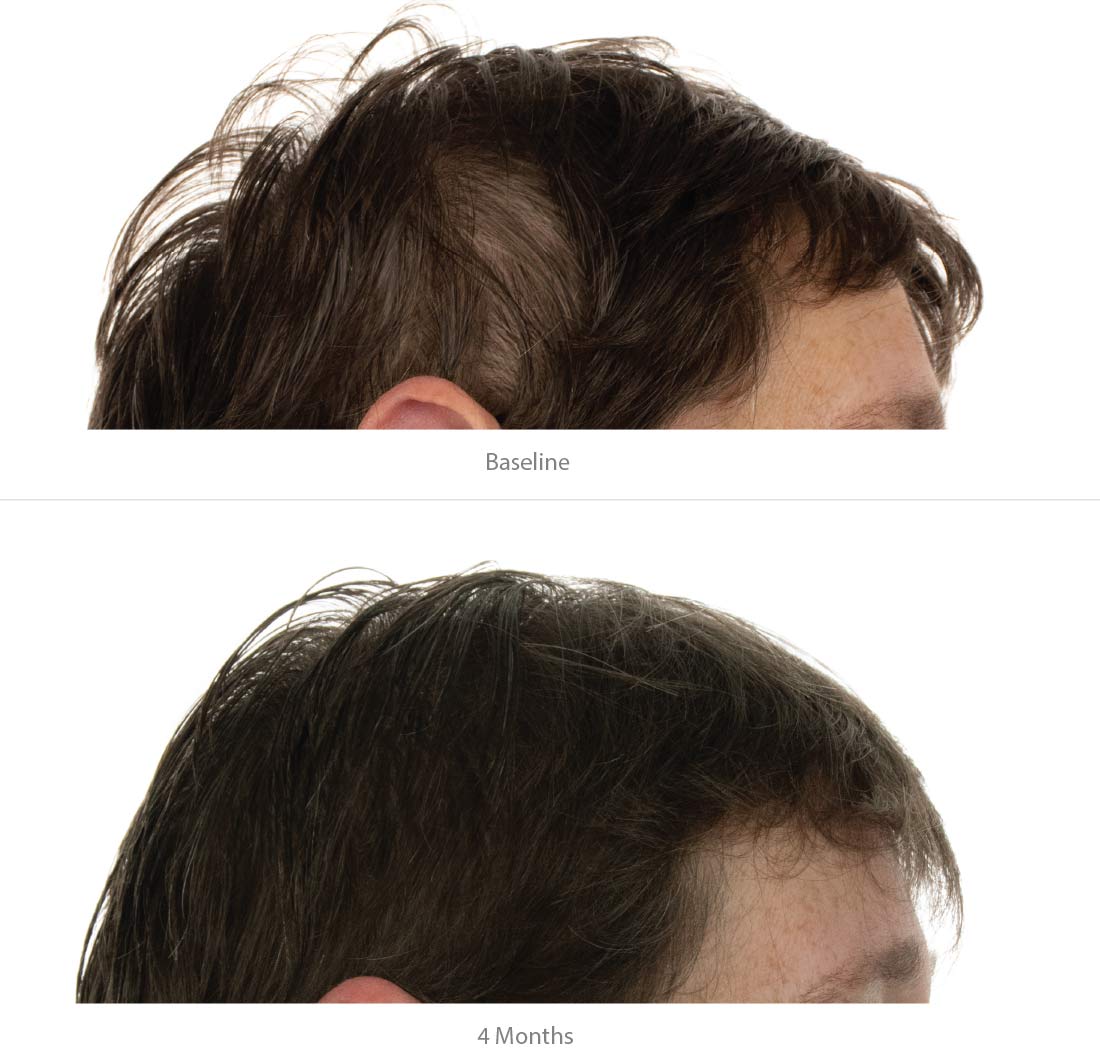 FOLIGAIN Triple Action Shampoo For Thinning Hair For Women with 2% TRIOXIDIL®