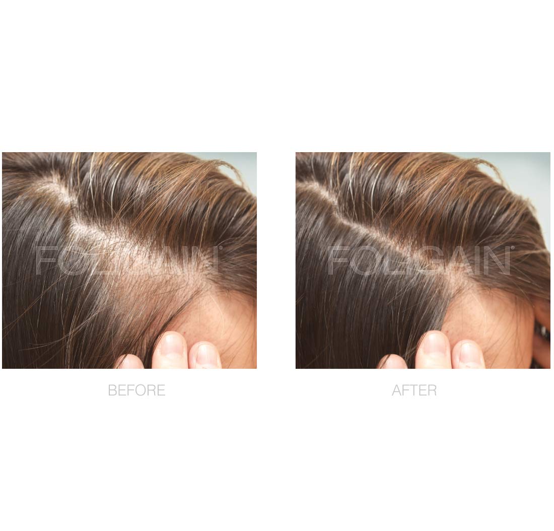 FOLIGAIN Minoxidil 2% Hair Regrowth Treatment For Women 3 Month Supply